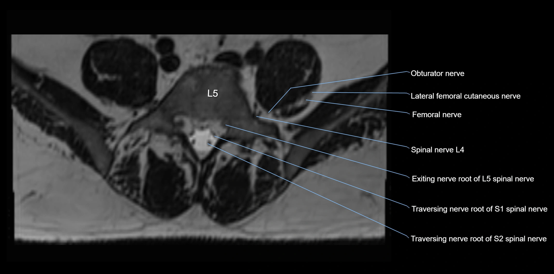 MR lumbosacral plexus axial cross sectional anatomy 3T  radiology  image-img-1008001-00054.webp